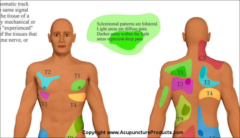 Sclerotome Pain Referral Patterns Poster