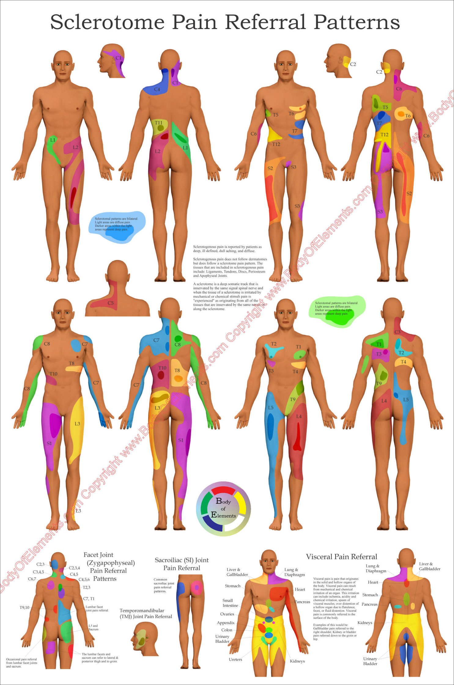 Sclerotome Pain Referral Poster