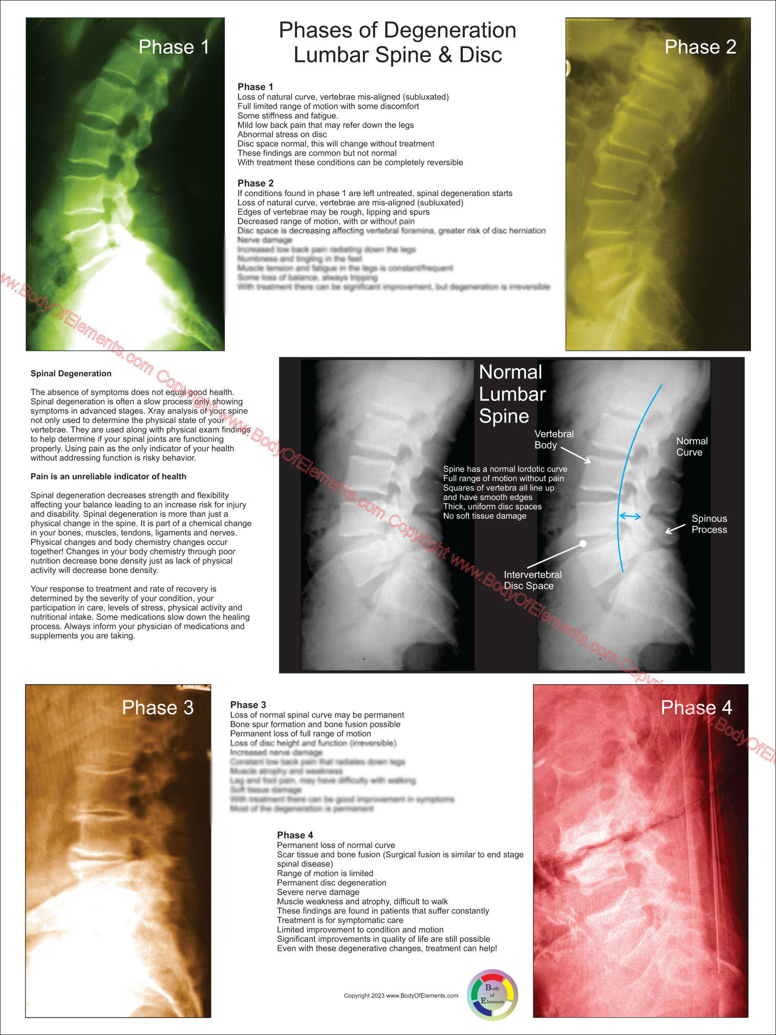 Lumbar Spinal Degeneration Poster