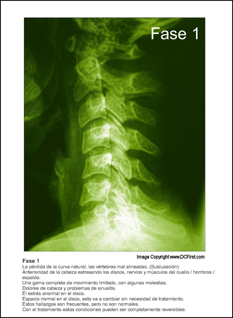 Spinal Degeneration Poster